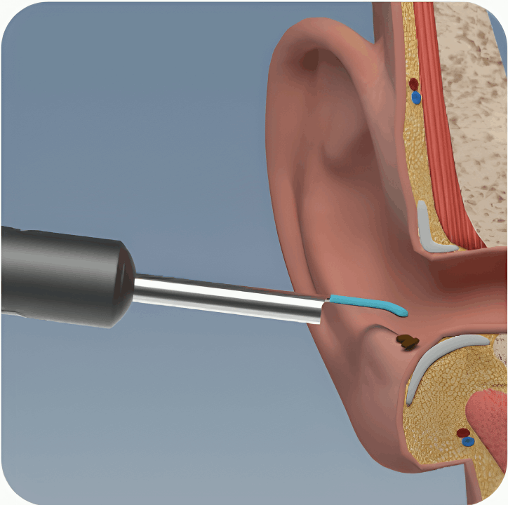 how to use Vital Ear Cleaner